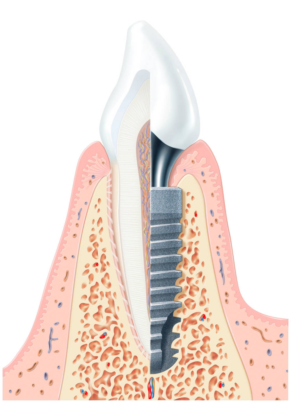 Anatomski presjek ugradnje Ankylos dentalnog implantata u kost s krunicom - Dental Centar Malnar Karlovac